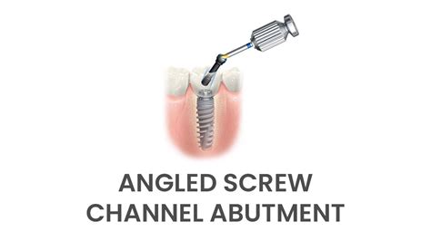 chanel screw|angled screw channel abutments.